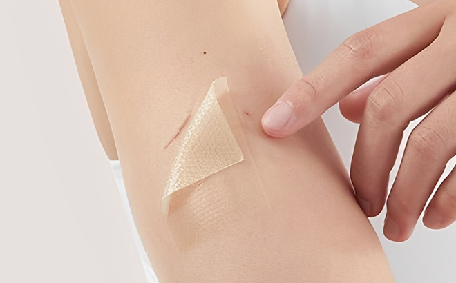 RWT Silicone Scar Sheet on the Hand